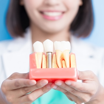 Dental Implants