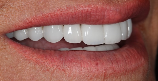 Veneers after