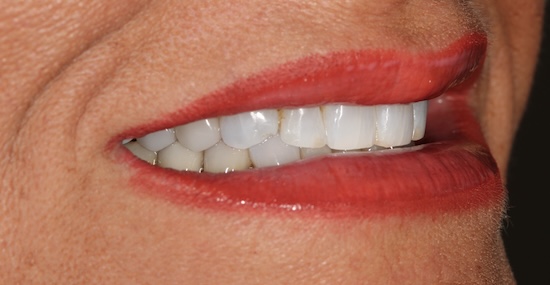 Veneers before